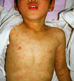 はしかってなあに 麻疹 はしか 沖縄県はしかゼロプロジェクト